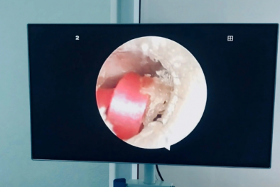 Dây buộc tóc bằng cao su nằm trong ống tai bé gái suýt gây thủng màng nhĩ
